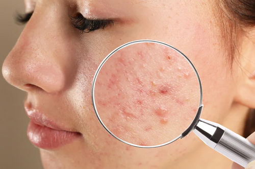 Acne Treatment