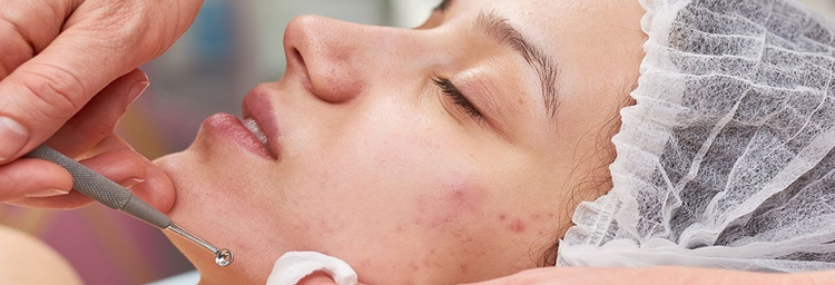 Acne Treatment