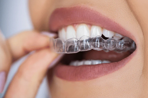 Aligners