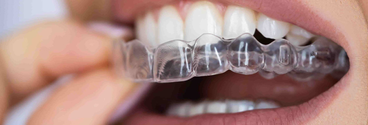 Aligners