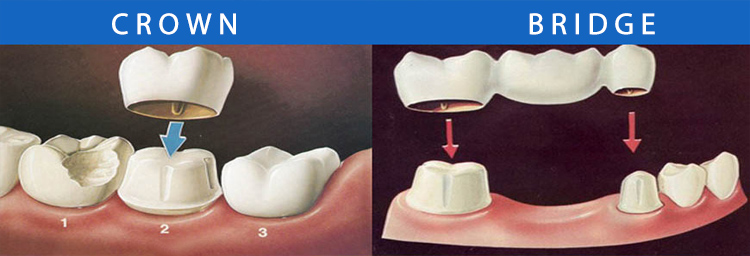 Root Canal Treatment