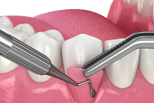 Flap Surgeries