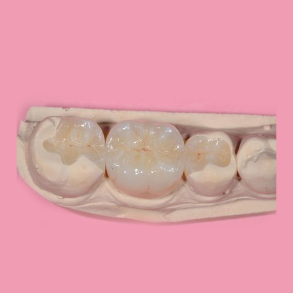 PARTIAL BONDED RESTORATIONS