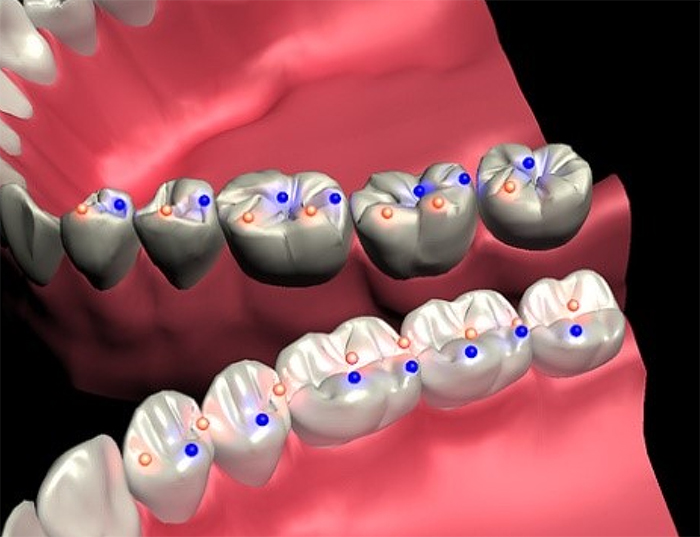 OCCLUSION