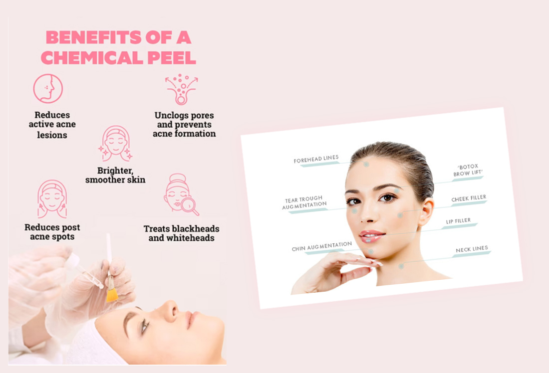 CHEMICAL PEELS