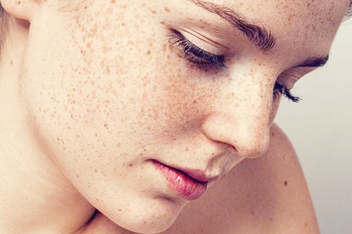 Melasma Treatment