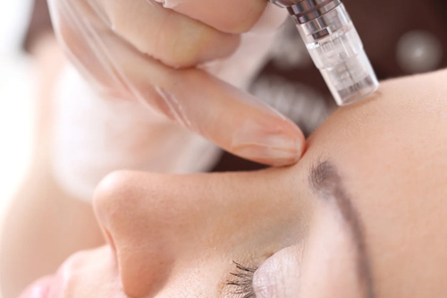 Microneedling