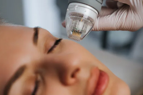 MNRF Laser Treatment