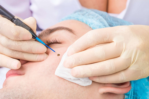 Mole Removal
