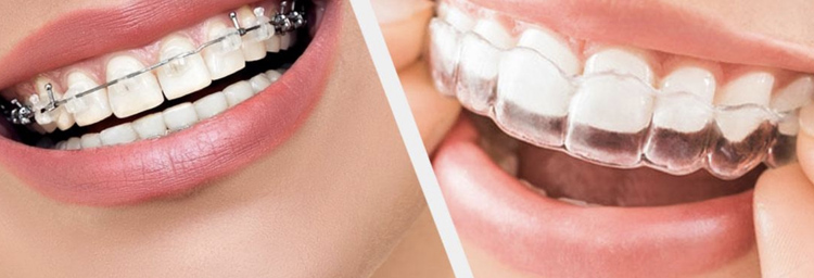 Orthodontic Treatment