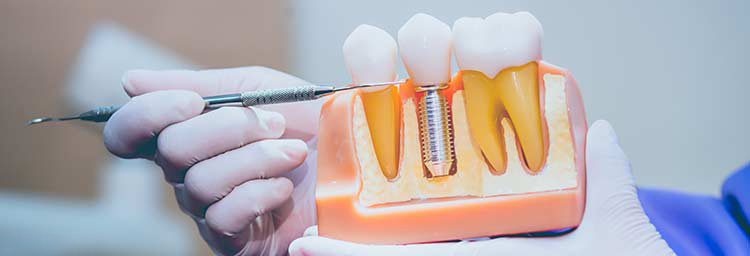 Root Canal Treatment
