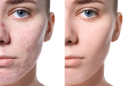 Scar Treatment