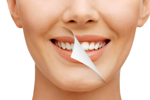 Smile Design