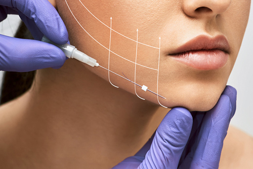 Thread Lift Treatment