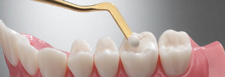 Root Canal Treatment