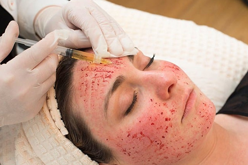 Vampire Facial / Face PRP