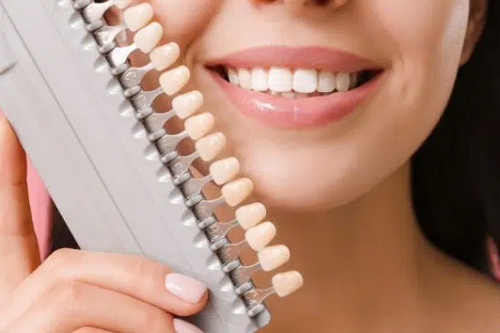 Veneers